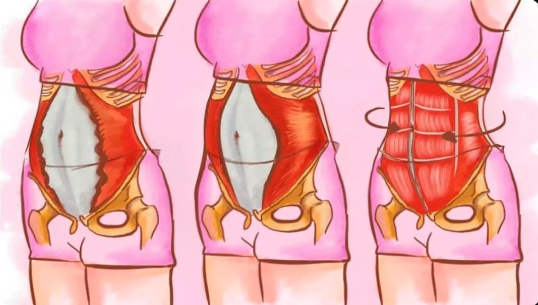 O que é diástase abdominal